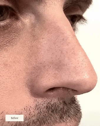 PATCHS POUR LE NEZ